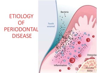 ETIOLOGY
OF
PERIODONTAL
DISEASE
 
