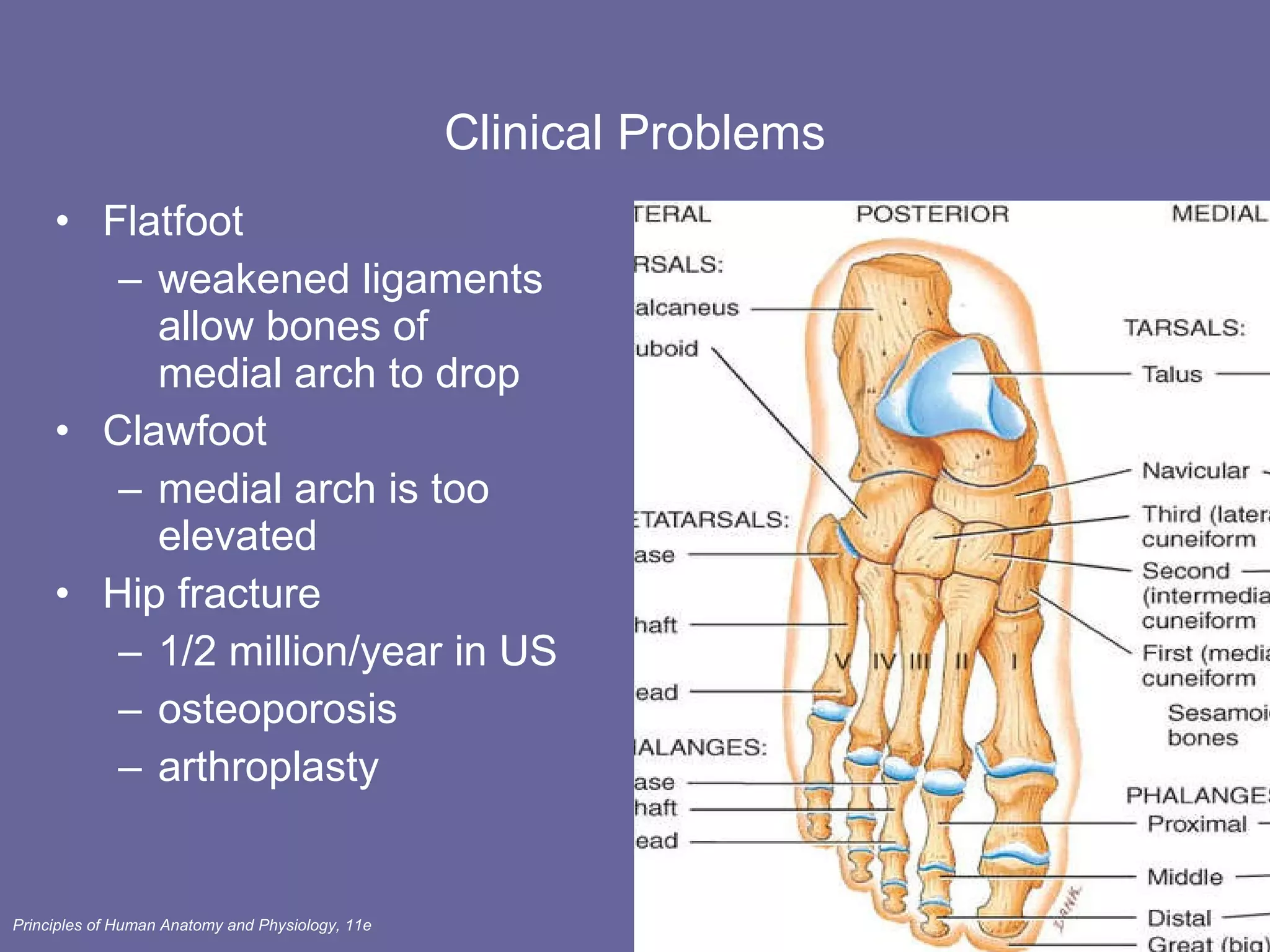 Clinical Problems Flatfoot weakened ligaments allow bones of medial arch to drop Clawfoot medial arch is too elevated Hip fracture  1/2 million/year in US osteoporosis arthroplasty 
