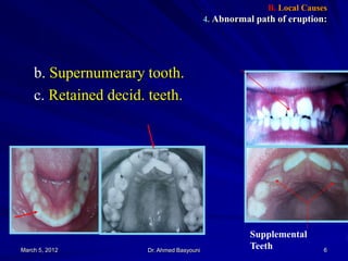 Etiology of Malocclusion II | PDF