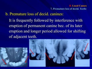 B. Local Causes
7. Premature loss of decid. Teeth:

b. Premature loss of decid. canines:
It is frequently followed by interference with
eruption of permanent canine bec. of its later
eruption and longer period allowed for shifting
of adjacent teeth.

March 5, 2012

Dr. Ahmed Basyouni

6

 