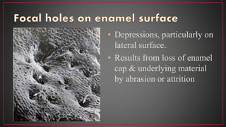 • Depressions, particularly on
lateral surface.
• Results from loss of enamel
cap & underlying material
by abrasion or attrition
 