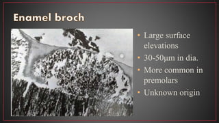 • Large surface
elevations
• 30-50μm in dia.
• More common in
premolars
• Unknown origin
 