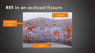 Enamel
Enamel
Columnar
cells
 