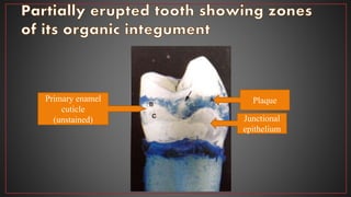 Primary enamel
cuticle
(unstained) Junctional
epithelium
Plaque
 