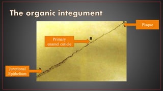 Junctional
Epithelium
Primary
enamel cuticle
Plaque
 