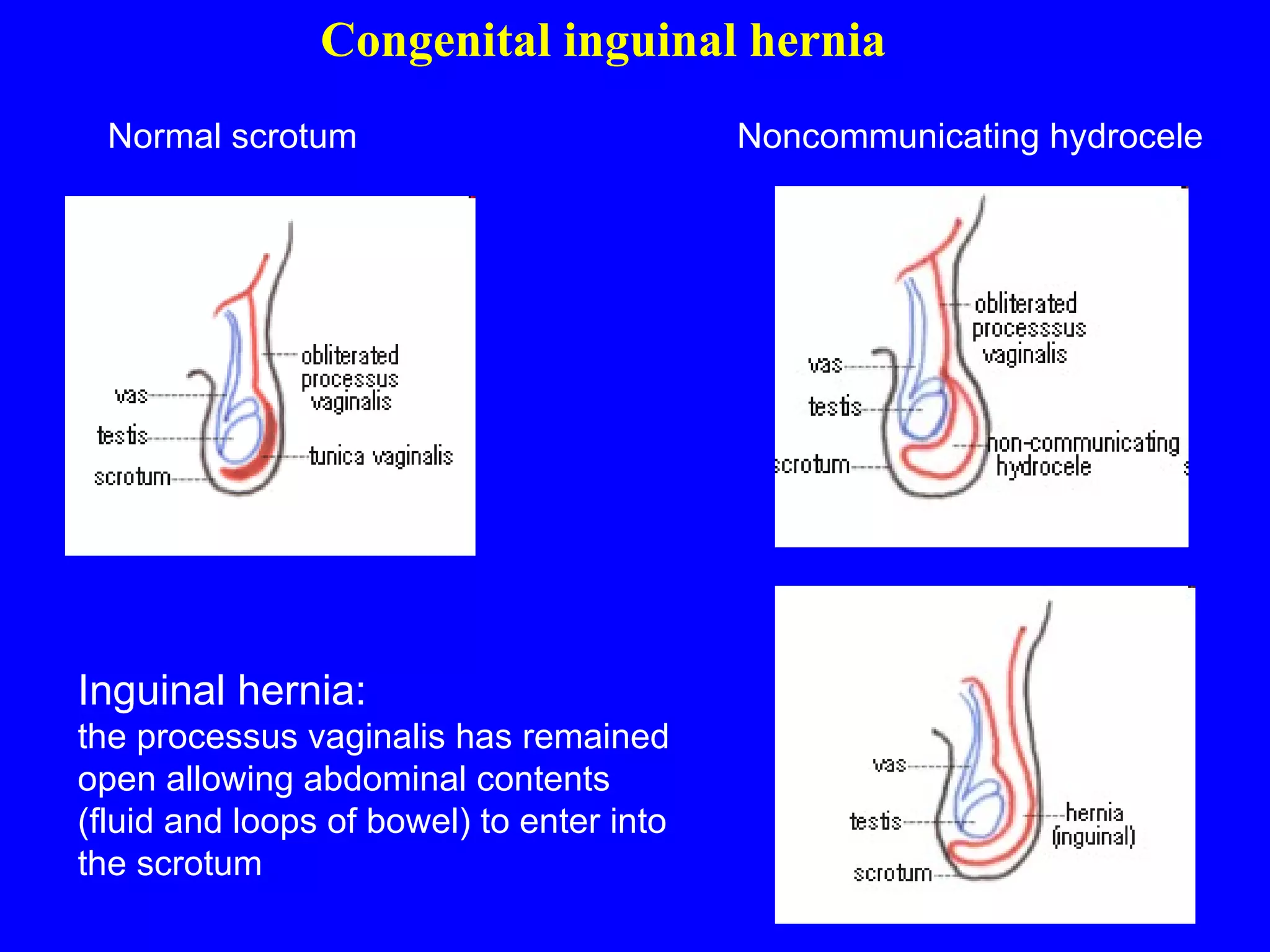 Congenital inguinal hernia Inguinal hernia: the processus vaginalis has remained open allowing abdominal contents (fluid and loops of bowel) to enter into the scrotum Noncommunicating hydrocele Normal scrotum 