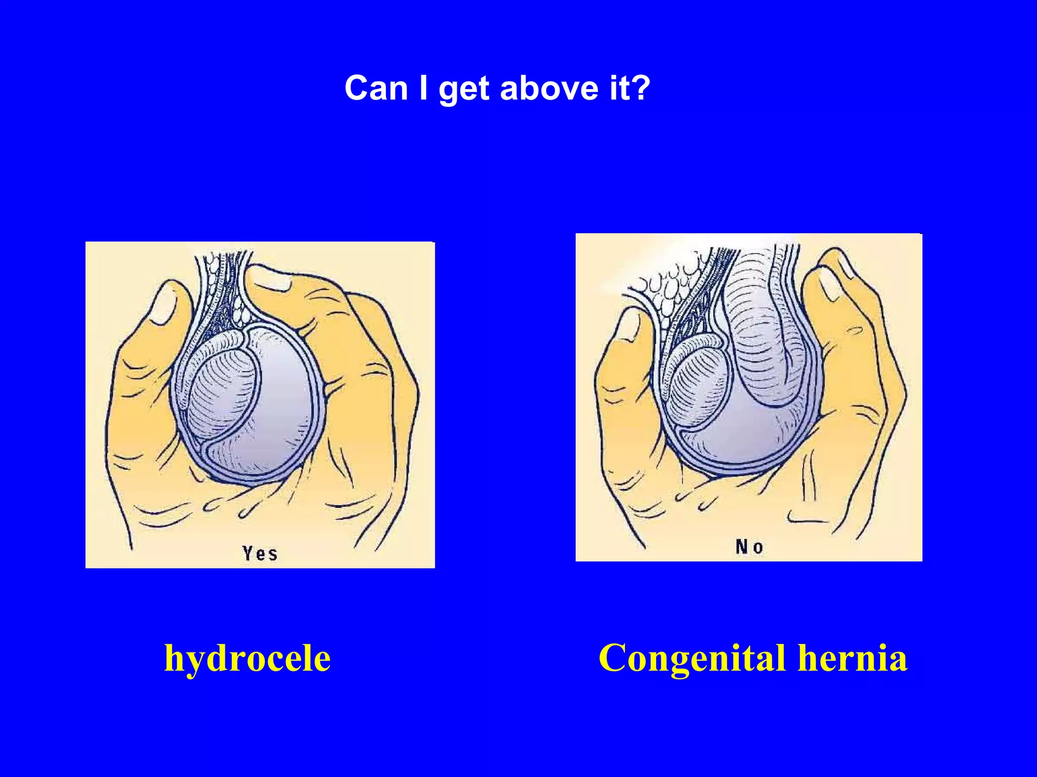 Can I get above it? hydrocele Congenital hernia 