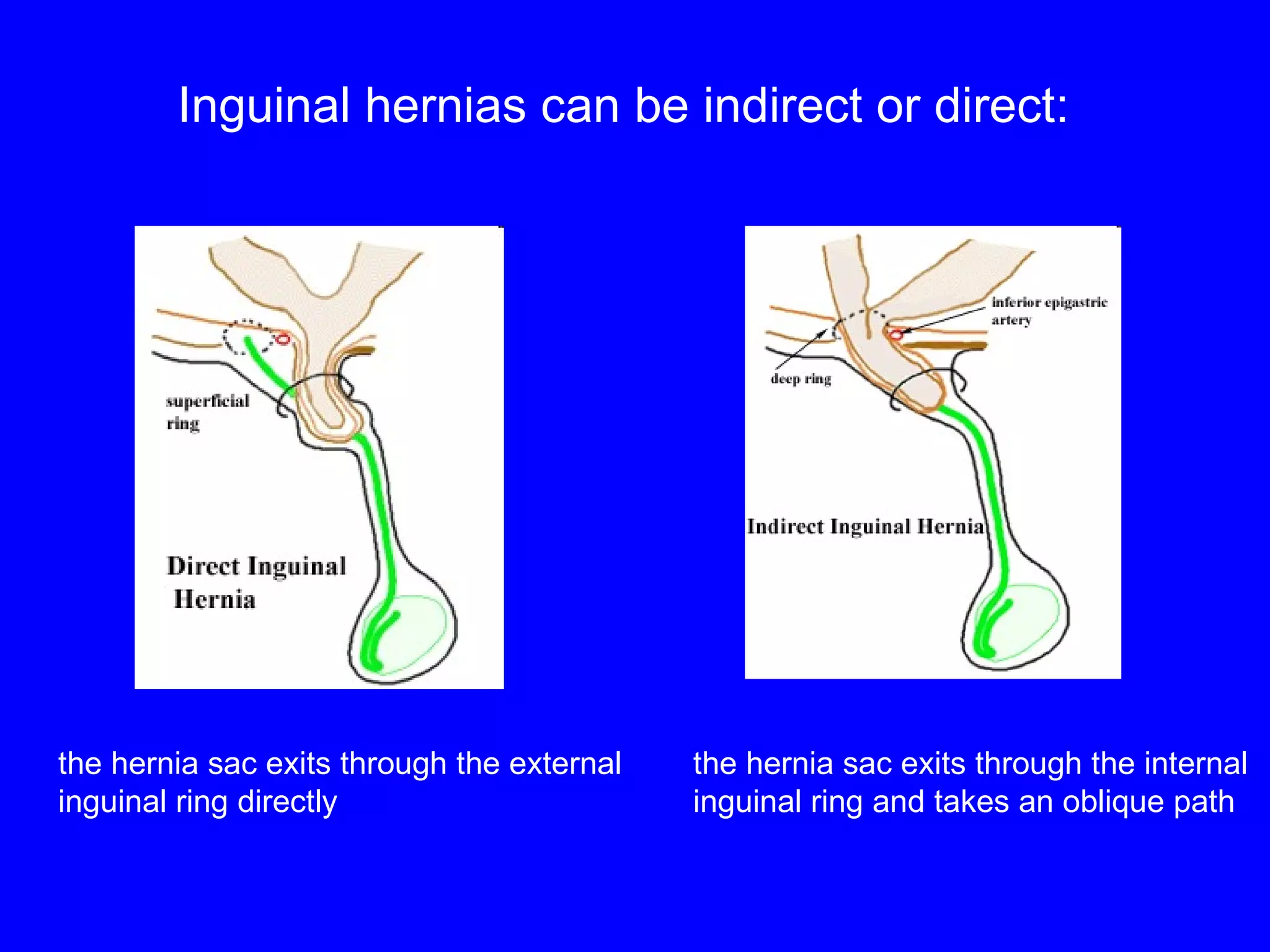 the hernia sac exits through the internal  inguinal ring and takes an oblique path the hernia sac exits through the external  inguinal ring directly Inguinal hernias can be indirect or direct: 