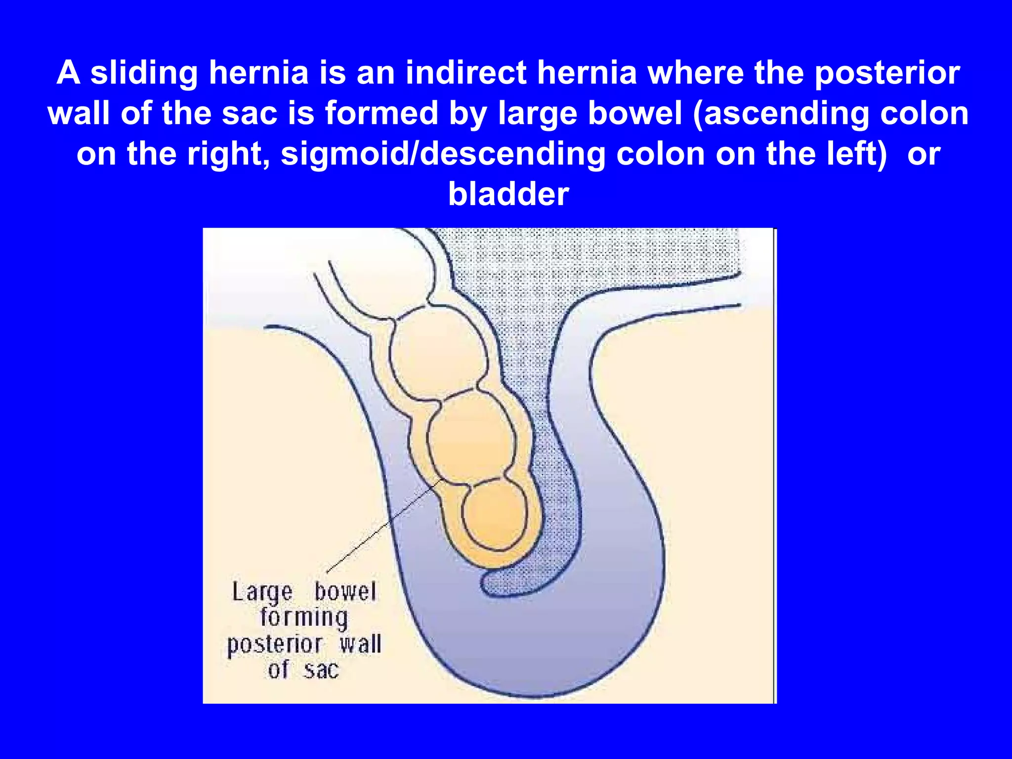 A sliding hernia is an indirect hernia where the posterior wall of the sac is formed by large bowel (ascending colon on the right, sigmoid/descending colon on the left)  or bladder 