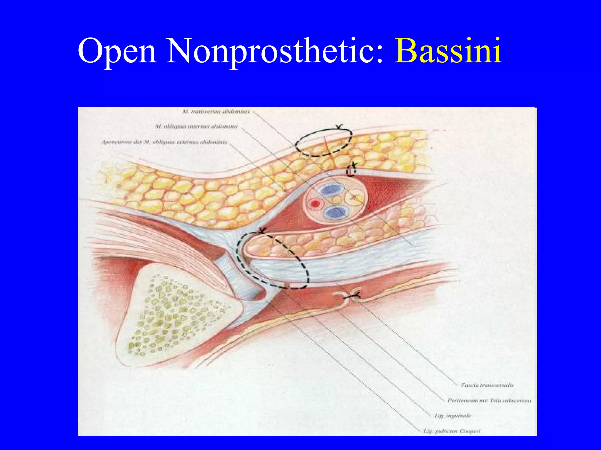 Open Nonprosthetic:  Bassini 