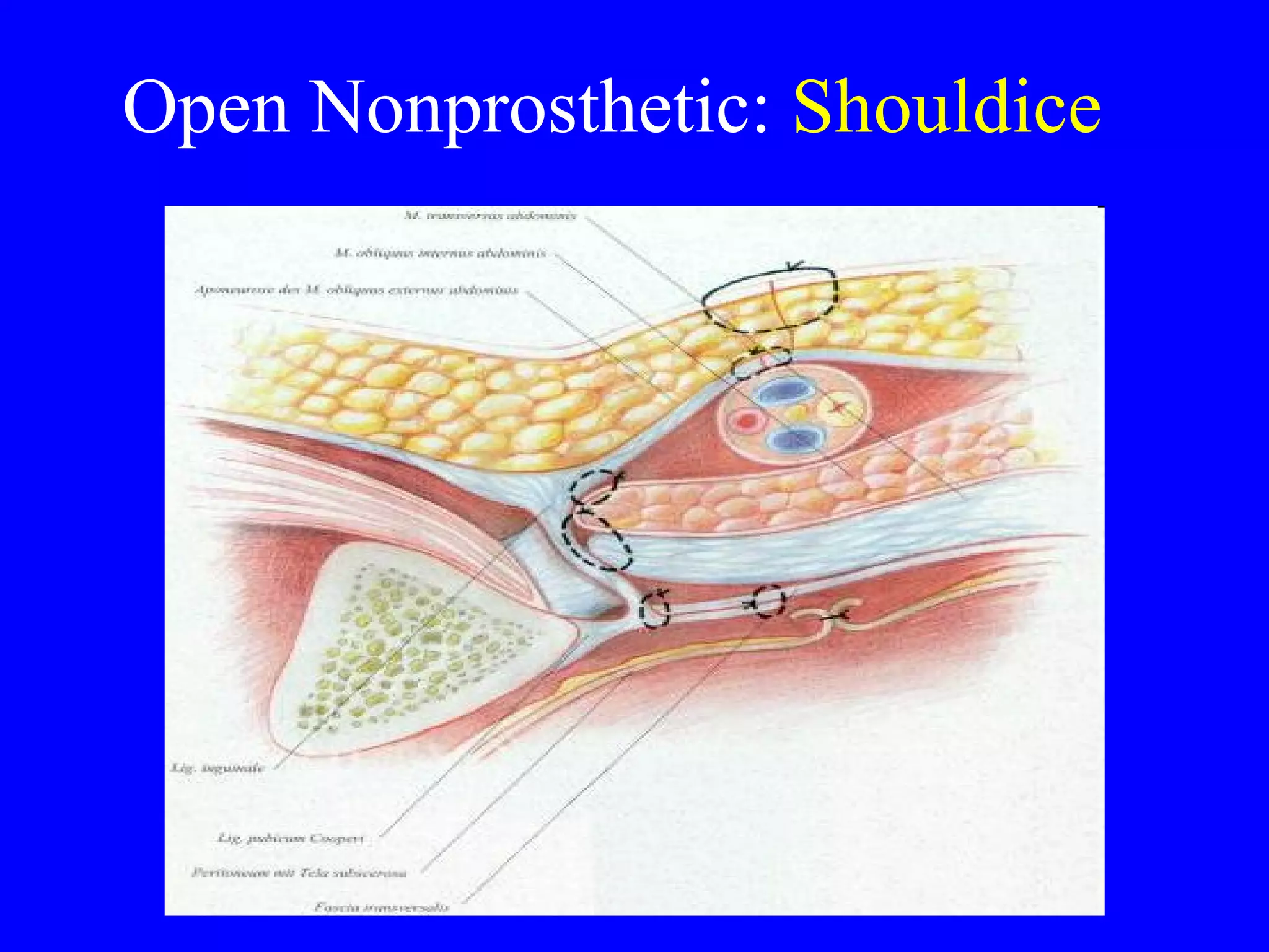 Open Nonprosthetic:  Shouldice 