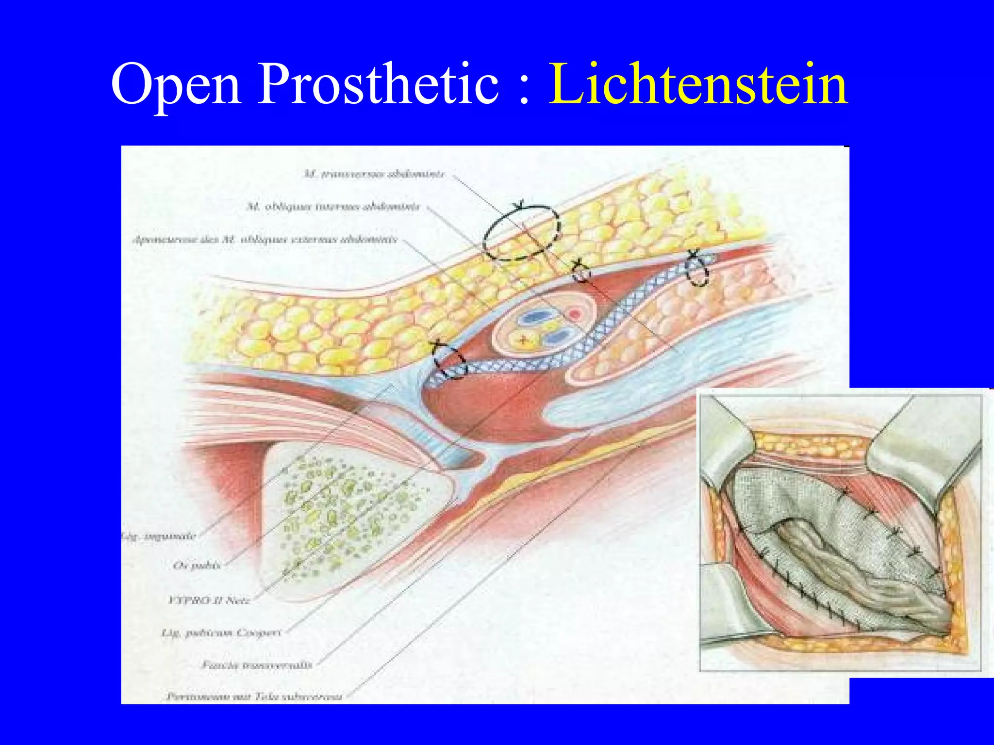 Open Prosthetic :  Lichtenstein 