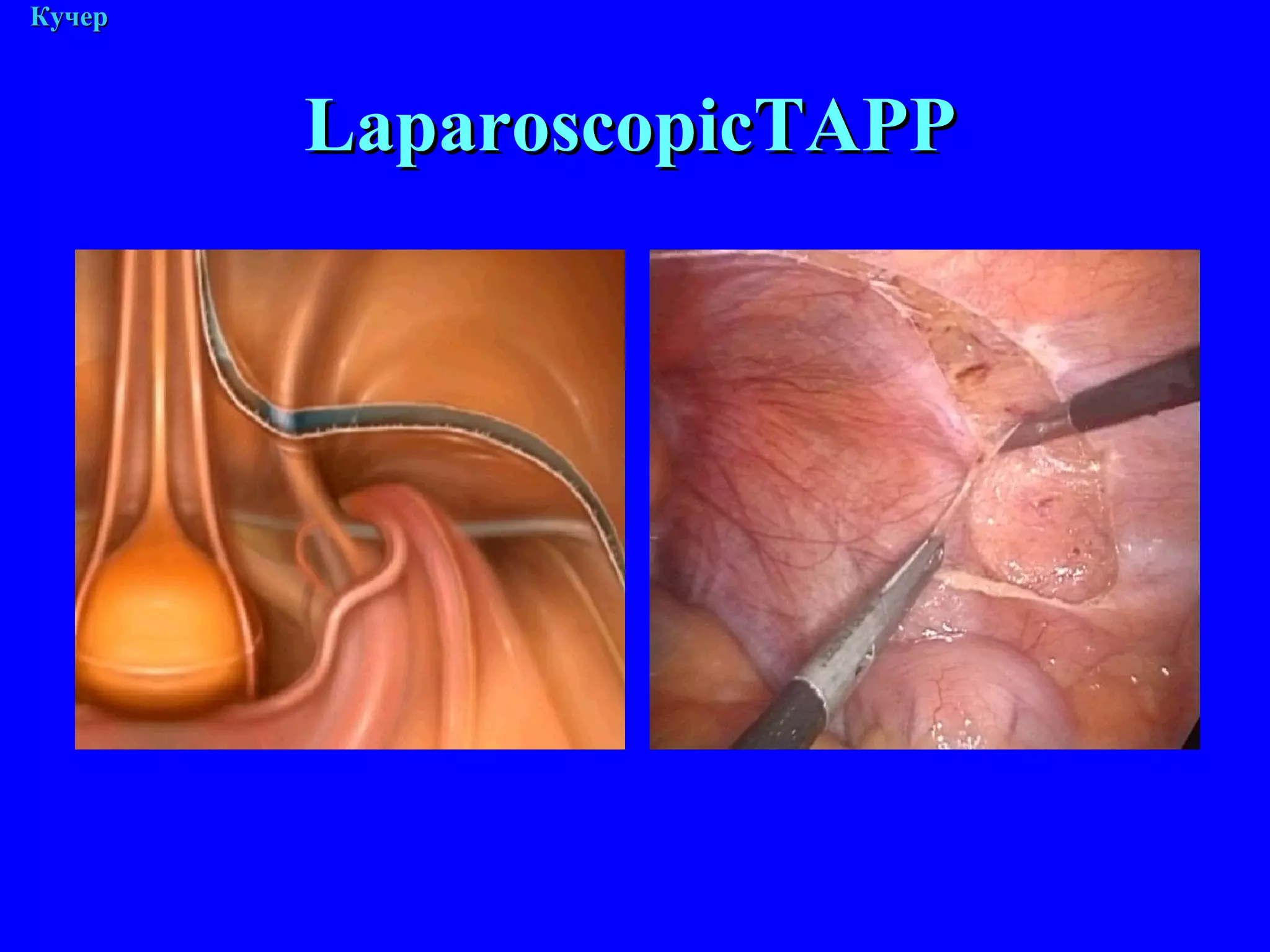 М. Кучер Laparoscopic ТАРР 