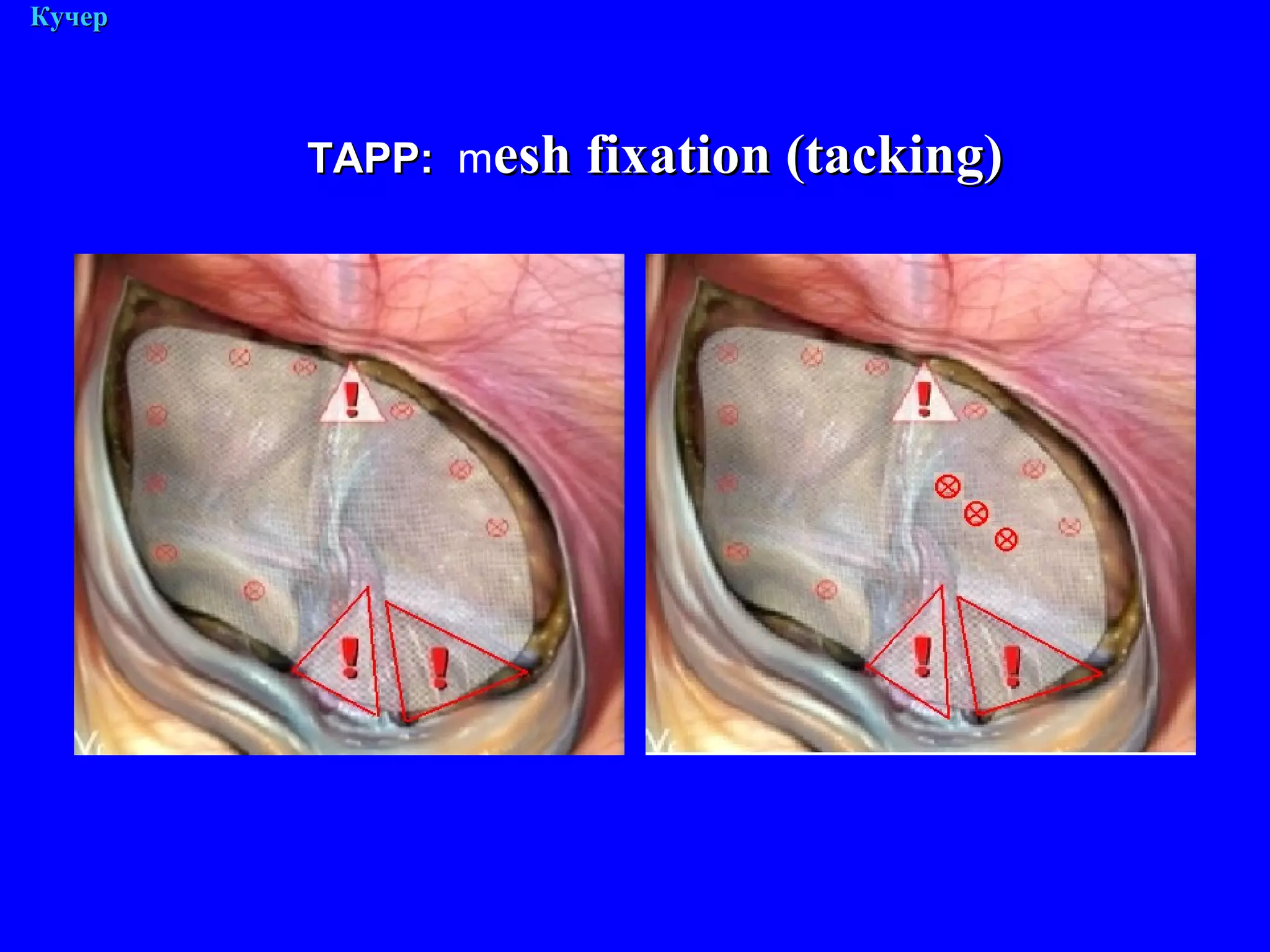 М. Кучер ТАРР :   m esh fixation (tacking) 