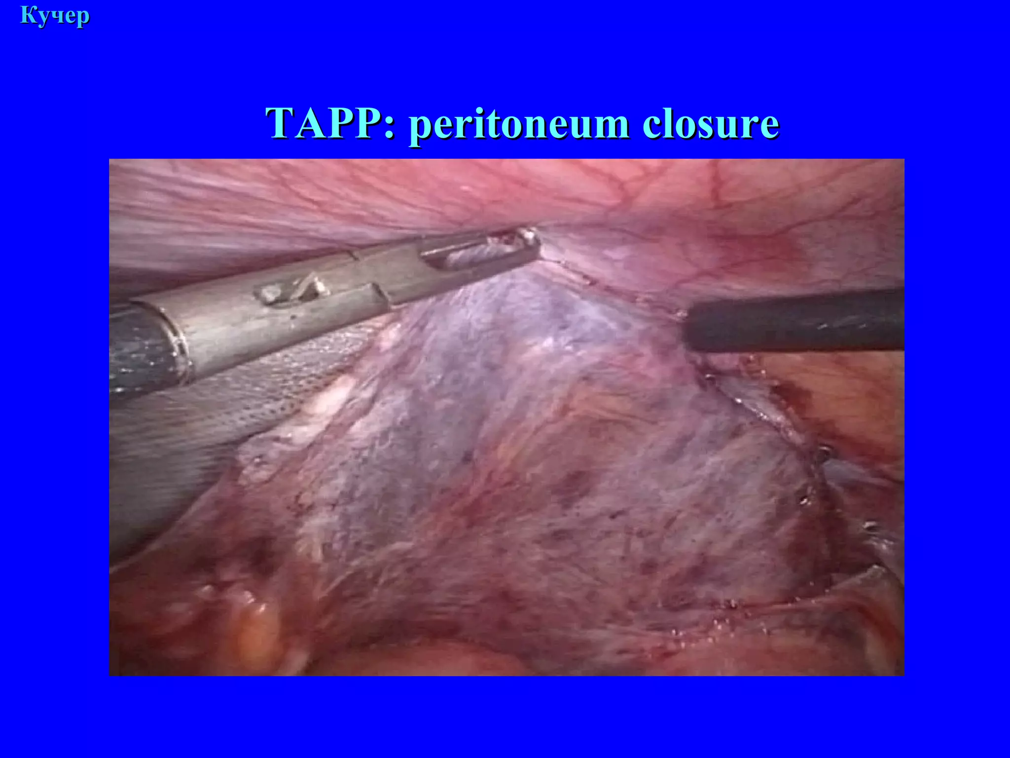 М. Кучер ТАРР : peritoneum closure 