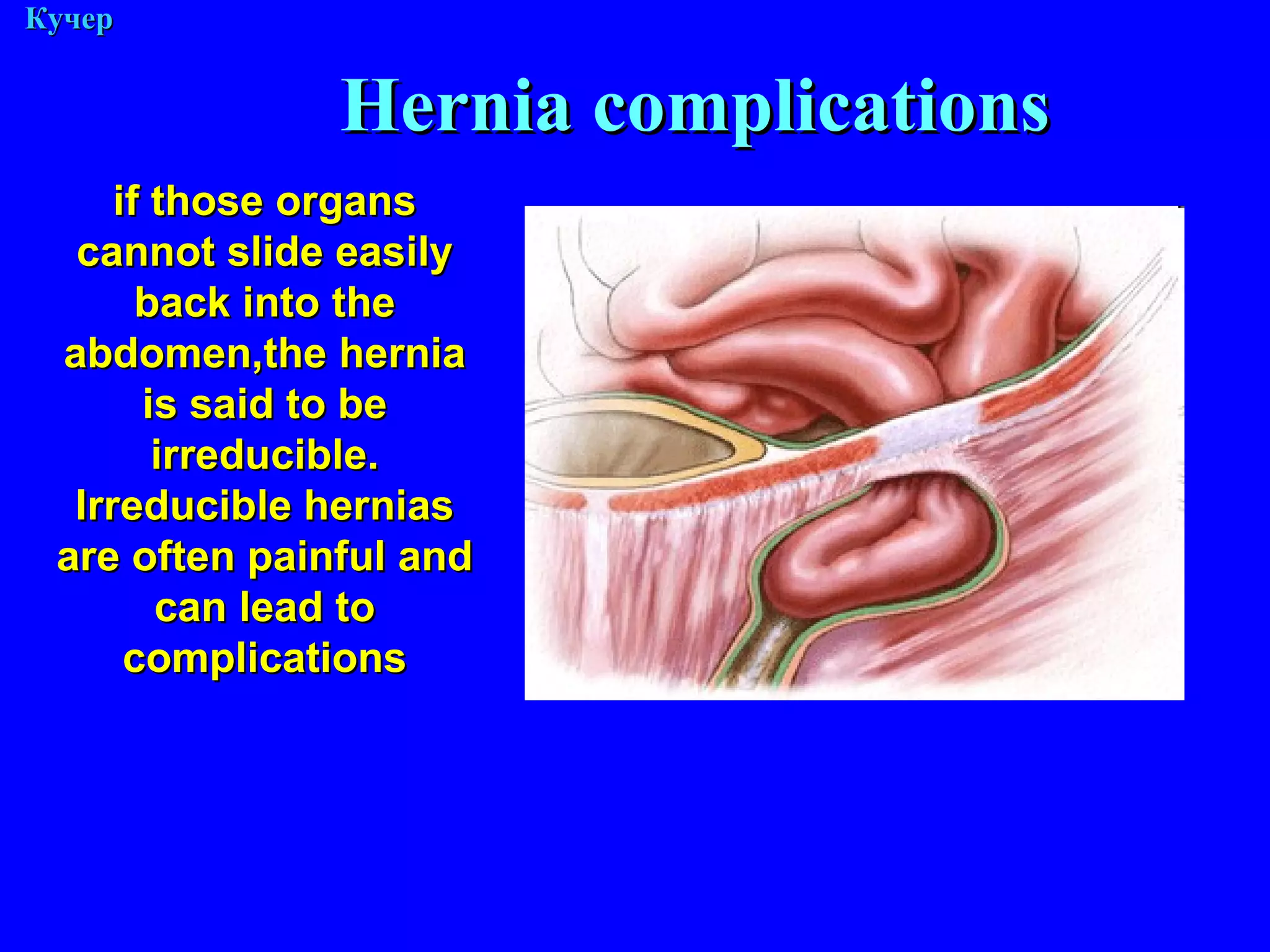 М. Кучер if those organs cannot slide easily back into the abdomen,the hernia is said to be irreducible. Irreducible hernias are often painful and can lead to complications Hernia complications 