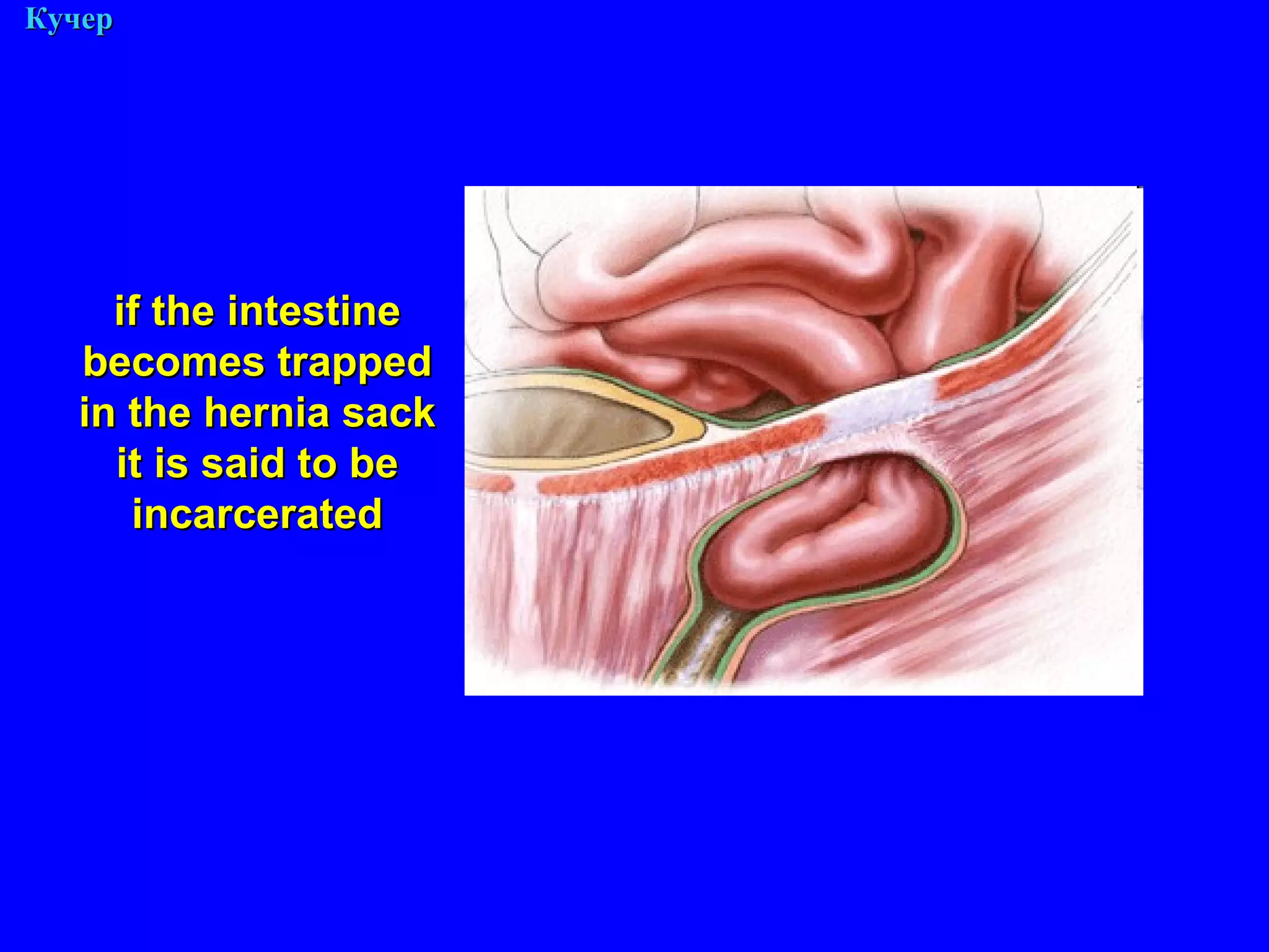 М. Кучер if the intestine becomes trapped in the hernia sack it is said to be incarcerated 
