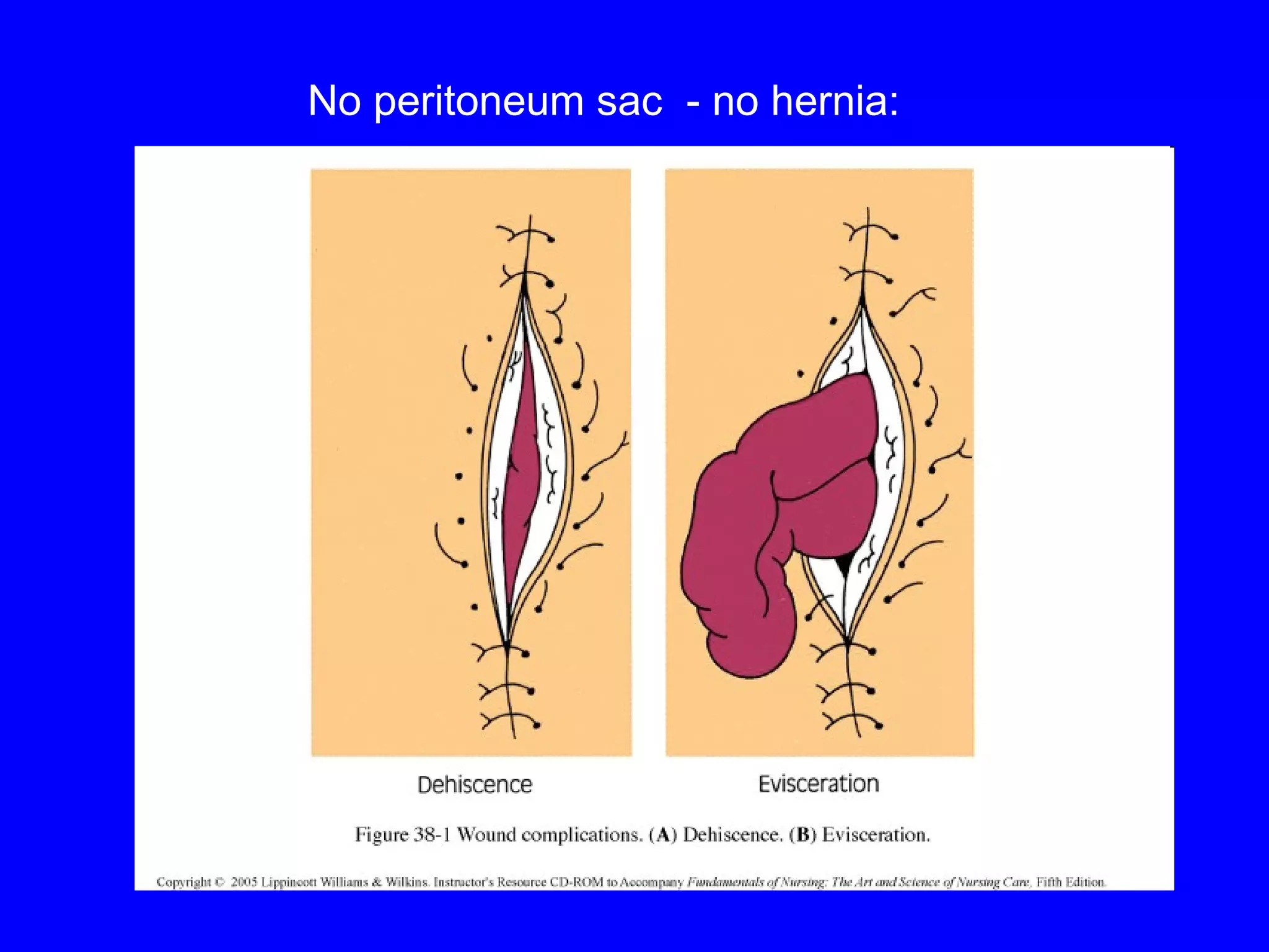 INCIDENCE No  peritoneum sac  - no hernia: 