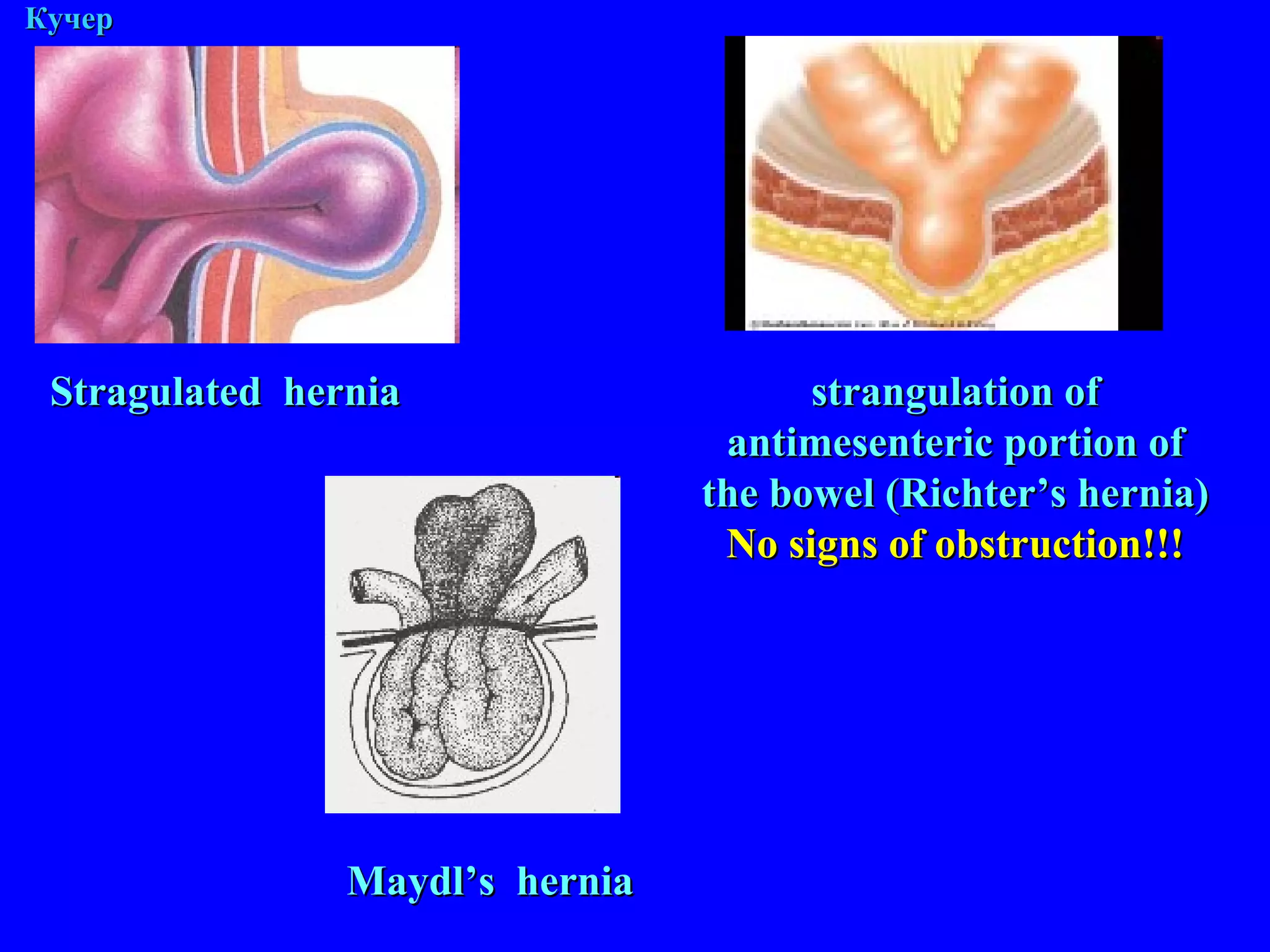 М. Кучер strangulation of antimesenteric portion of the bowel (Richter’s hernia) No signs of obstruction!!! Stragulated  hernia Maydl’s  hernia 