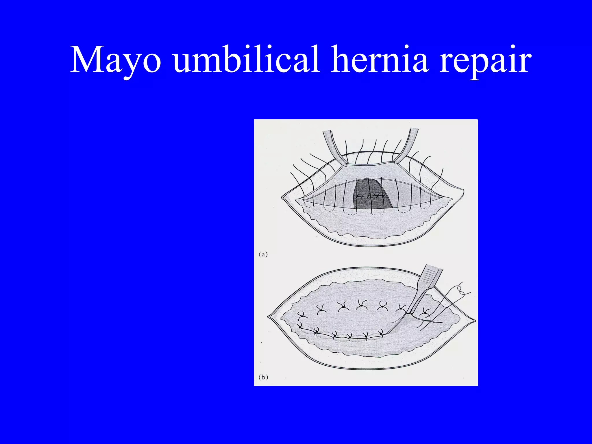 Mayo umbilical hernia repair 