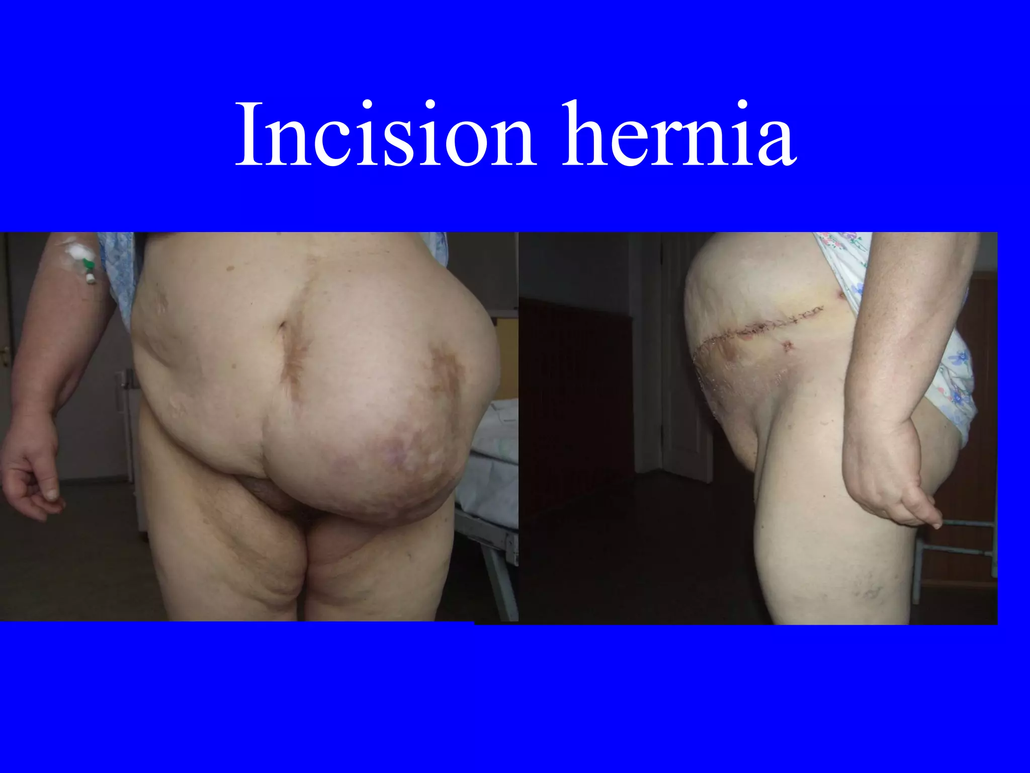 Incision hernia 
