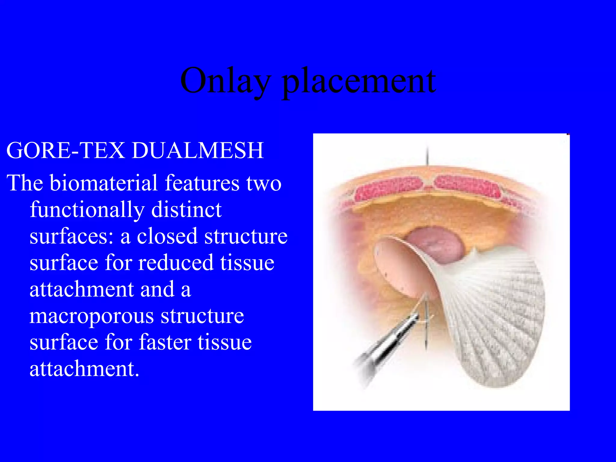Onlay placement GORE-TEX DUALMESH The biomaterial features two functionally distinct surfaces: a closed structure surface for reduced tissue attachment and a macroporous structure surface for faster tissue attachment. 