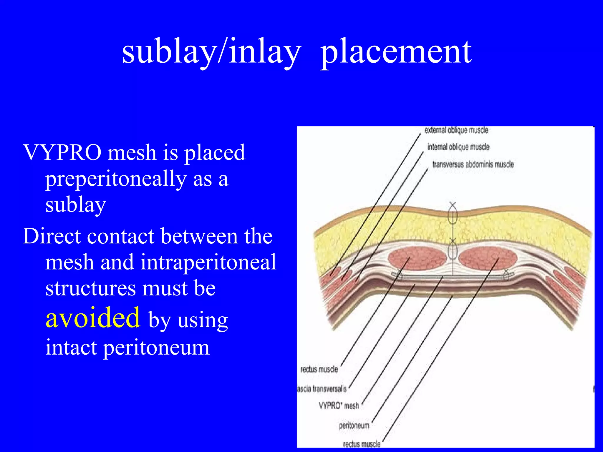 sublay/inlay  placement VYPRO mesh is placed preperitoneally as a sublay Direct contact between the mesh and intraperitoneal structures must be  avoided  by using intact peritoneum 