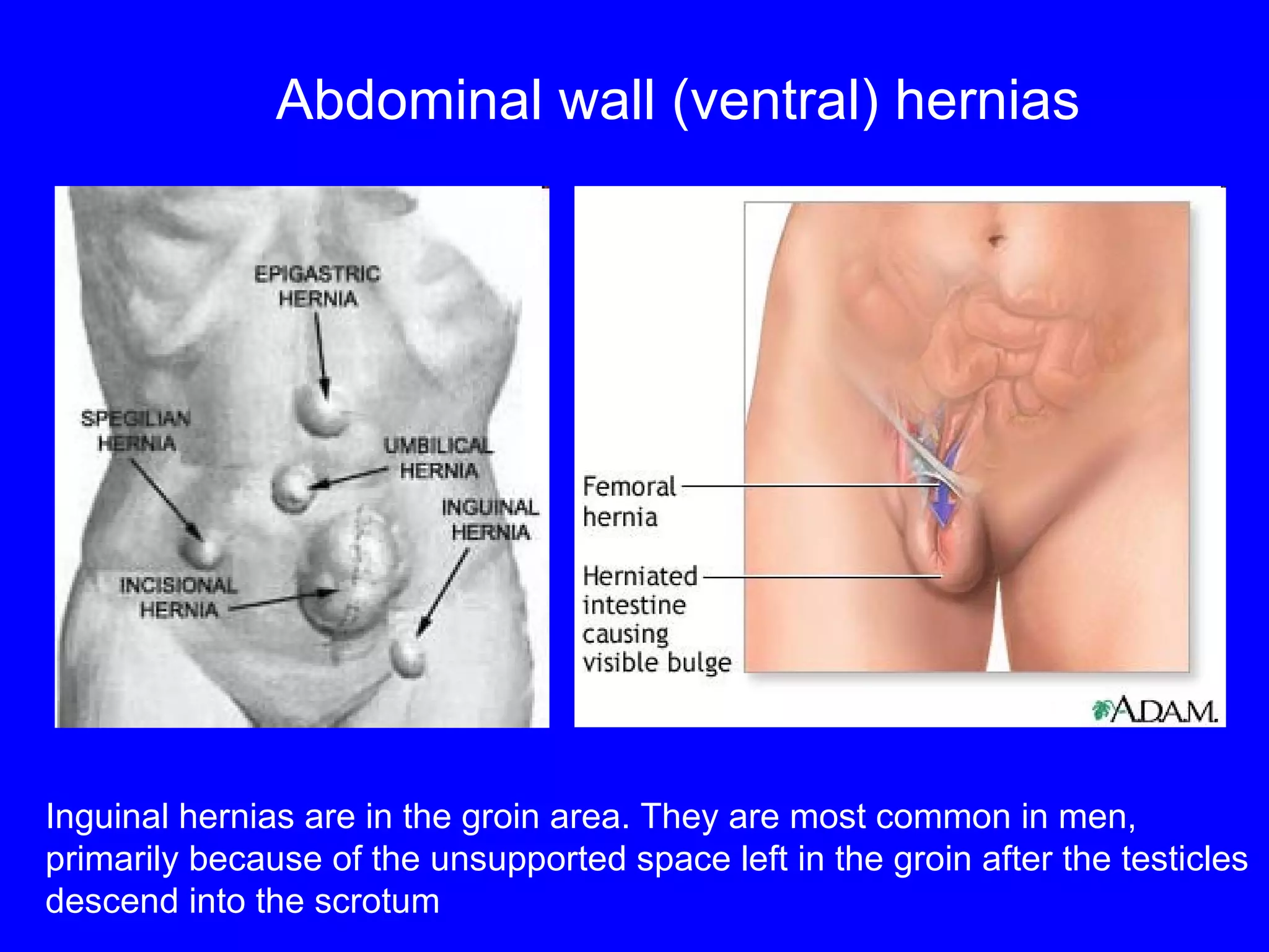 Abdominal wall (ventral)   hernias Inguinal hernias are in the groin area. They are most common in men,  primarily because of the unsupported space left in the groin after the testicles  descend into the scrotum  