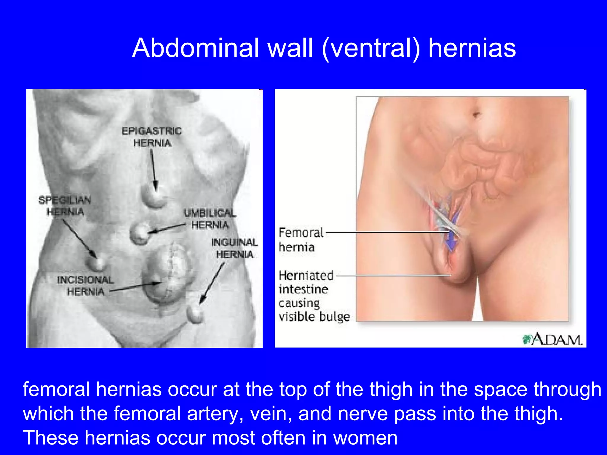 Abdominal wall (ventral)   hernias femoral hernias occur at the top of the thigh in the space through  which the femoral artery, vein, and nerve pass into the thigh.  These hernias occur most often in women   