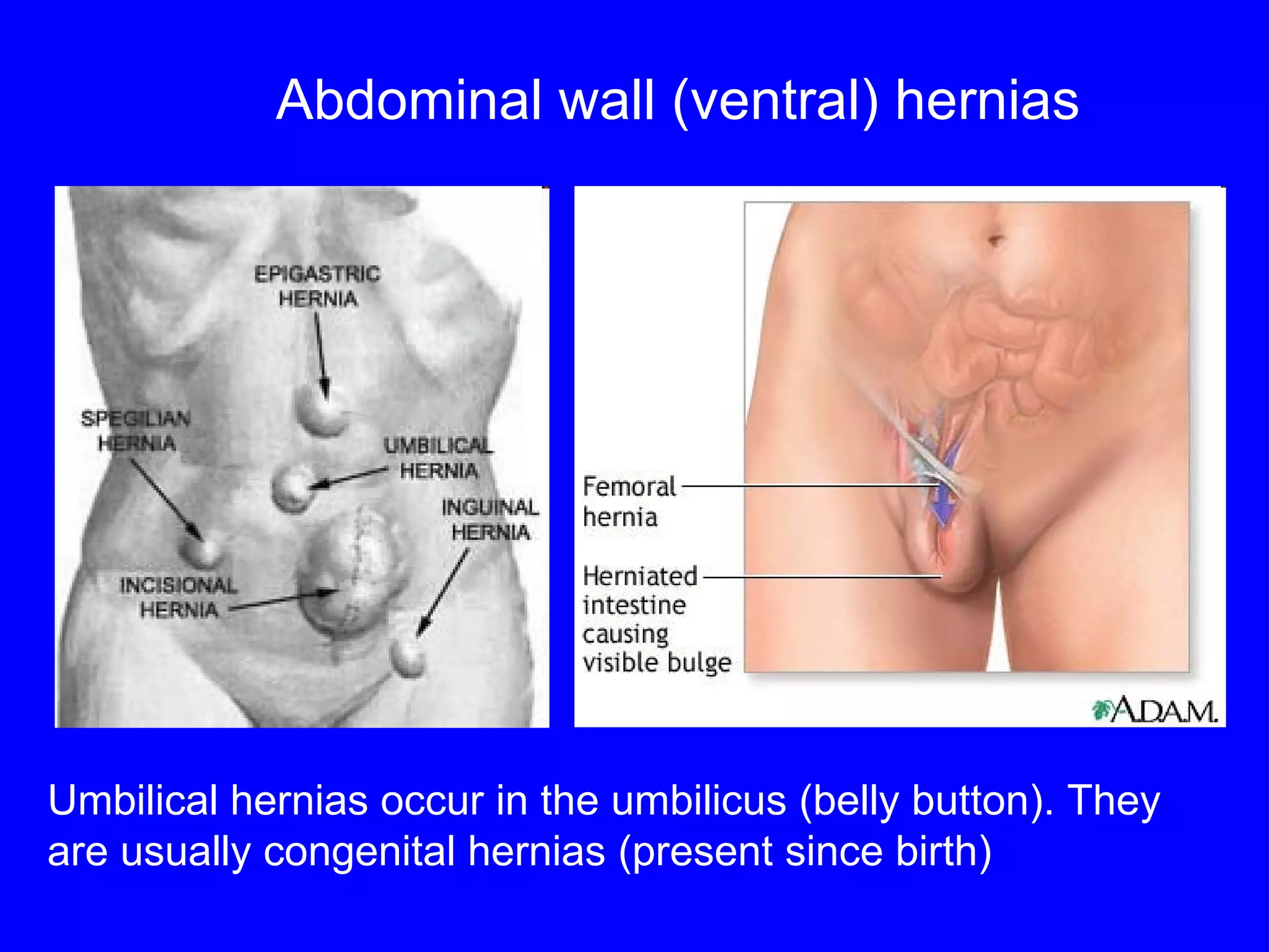 Abdominal wall (ventral)   hernias Umbilical hernias occur in the umbilicus (belly button). They are usually congenital hernias (present since birth) 