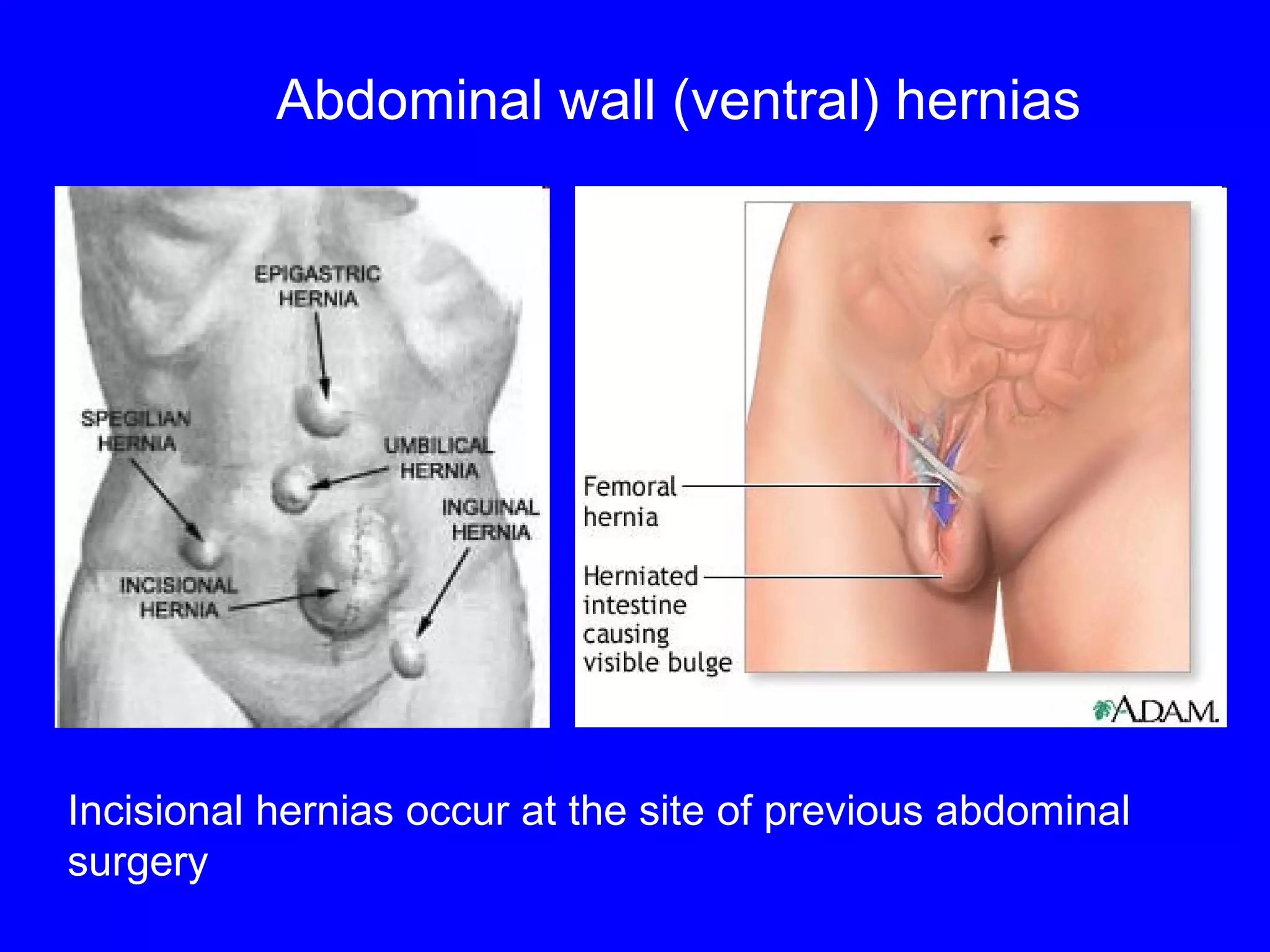 Abdominal wall (ventral)   hernias Incisional hernias occur at the site of previous abdominal surgery 