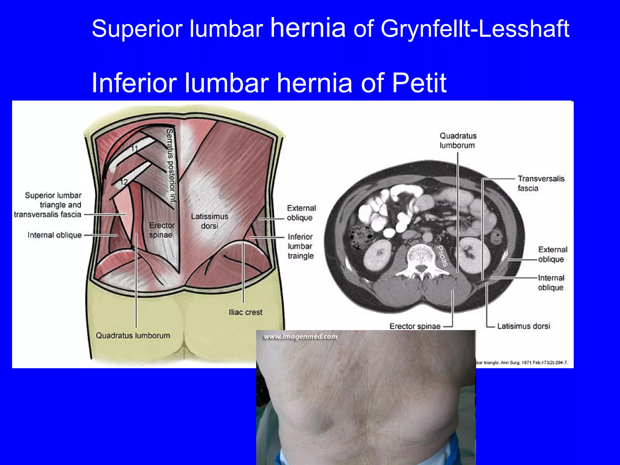 Inferior lumbar hernia of Petit Superior lumbar  hernia  of Grynfellt-Lesshaft 