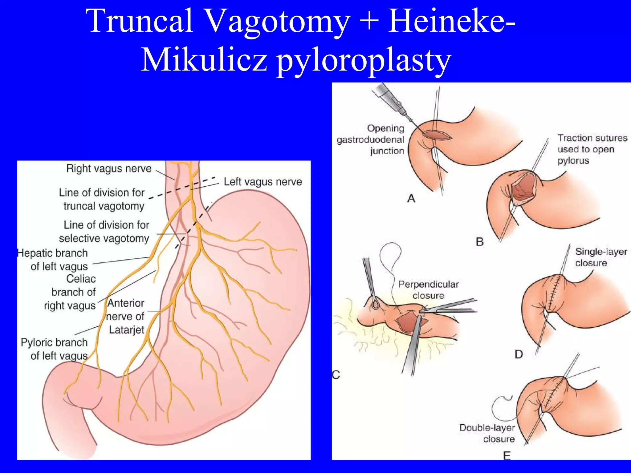 Truncal Vagotomy + Heineke-Mikulicz pyloroplasty   