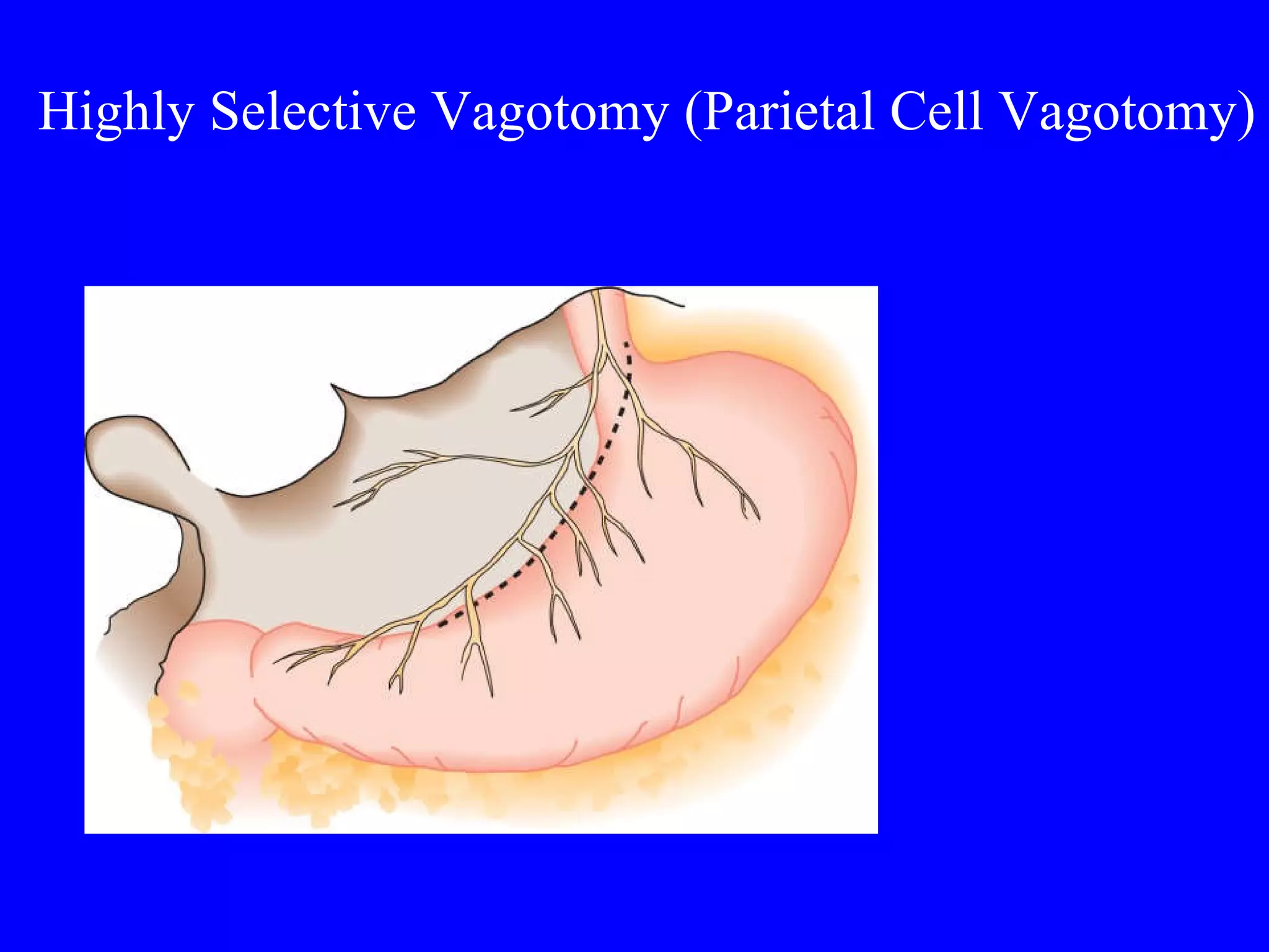 Highly Selective Vagotomy (Parietal Cell Vagotomy)   