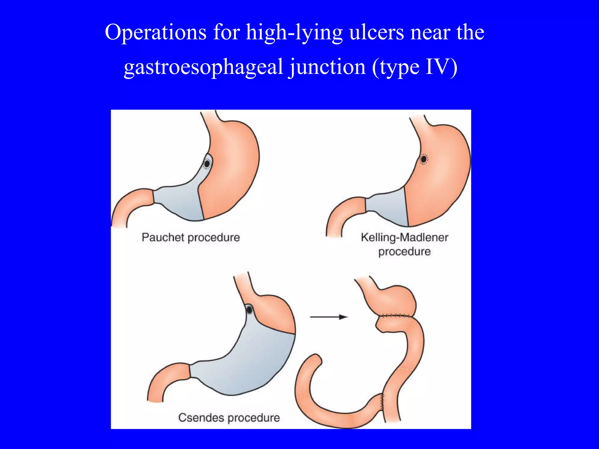 Operations for high-lying ulcers near the gastroesophageal junction (type IV)   