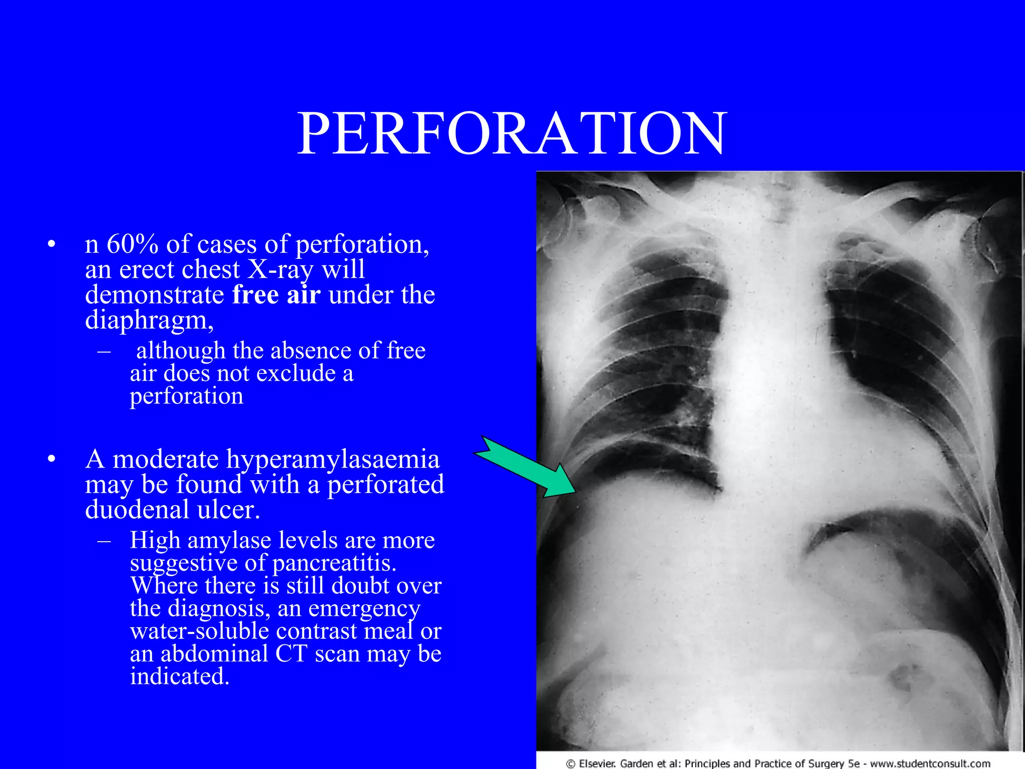 PERFORATION n 60% of cases of perforation, an erect chest X-ray will demonstrate  free air  under the diaphragm, although the absence of free air does not exclude a perforation  A moderate hyperamylasaemia may be found with a perforated duodenal ulcer.  High amylase levels are more suggestive of pancreatitis. Where there is still doubt over the diagnosis, an emergency water-soluble contrast meal or an abdominal CT scan may be indicated. 