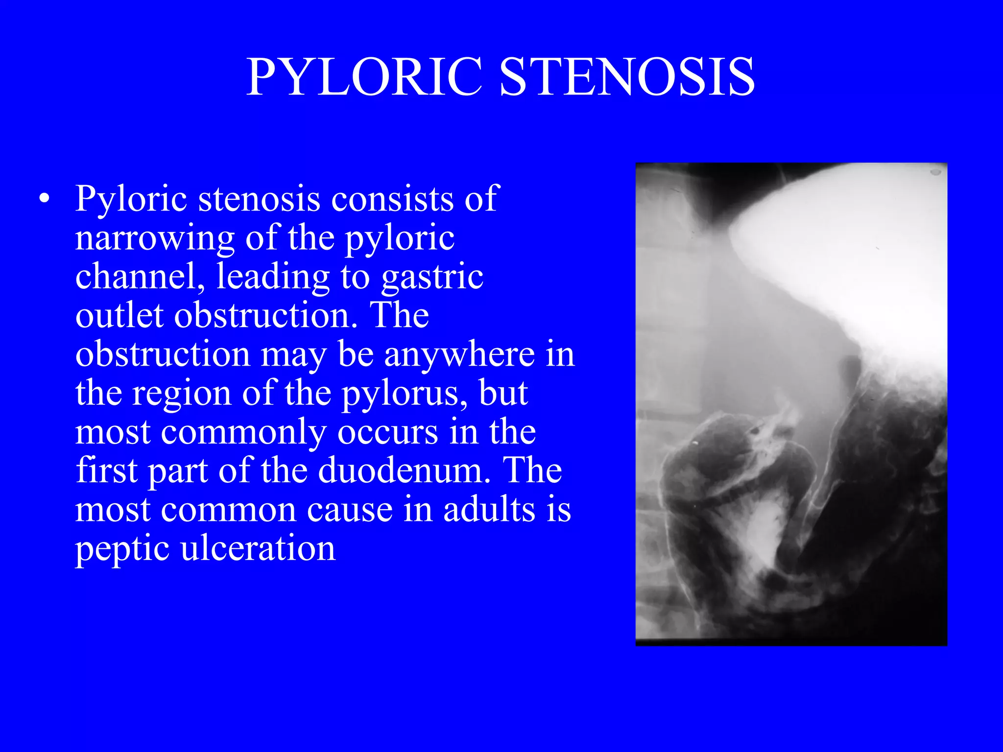 PYLORIC STENOSIS Pyloric stenosis consists of narrowing of the pyloric channel, leading to gastric outlet obstruction. The obstruction may be anywhere in the region of the pylorus, but most commonly occurs in the first part of the duodenum. The most common cause in adults is peptic ulceration 