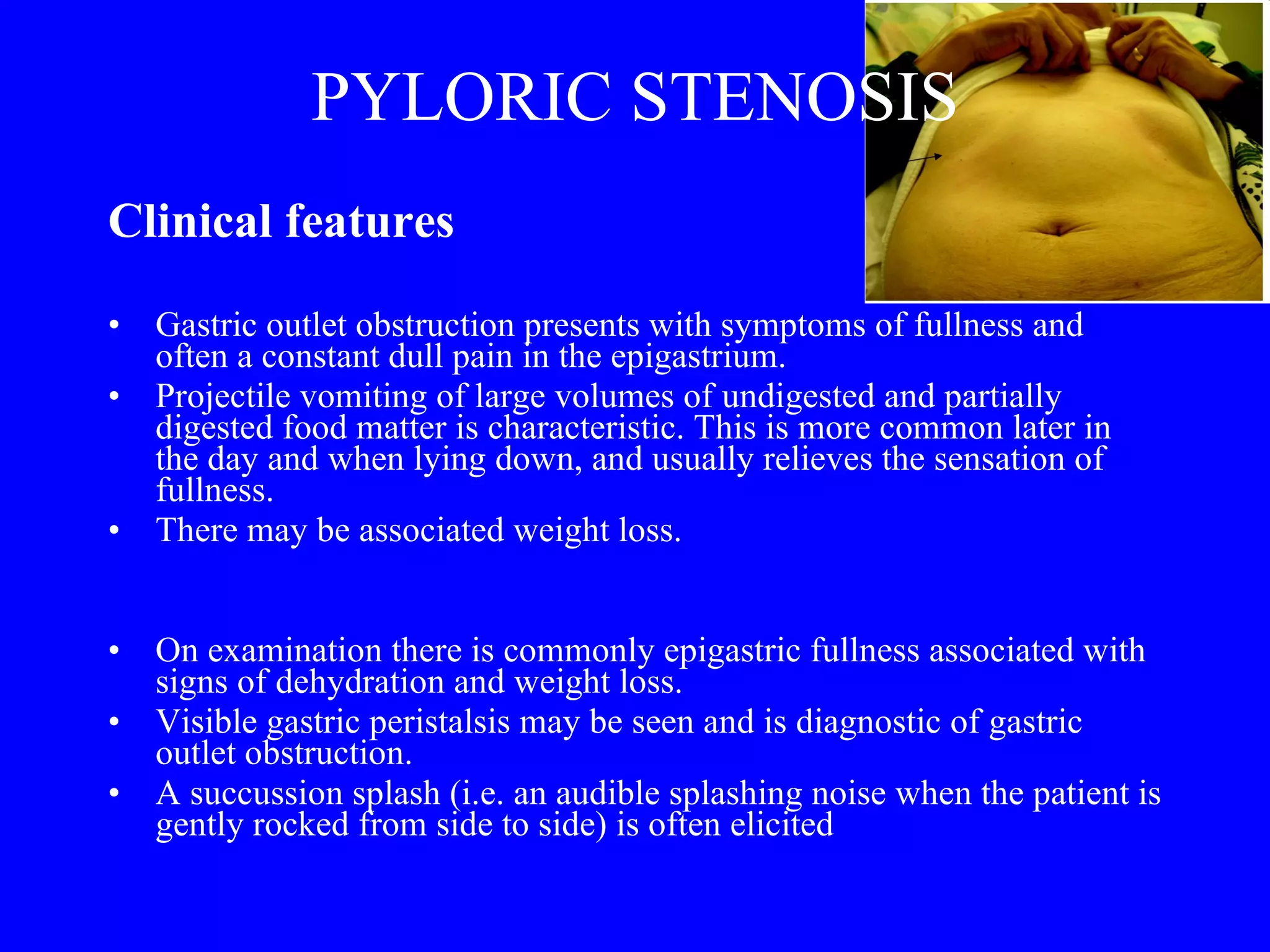 PYLORIC STENOSIS Clinical features  Gastric outlet obstruction presents with symptoms of fullness and often a constant dull pain in the epigastrium.  Projectile vomiting of large volumes of undigested and partially digested food matter is characteristic. This is more common later in the day and when lying down, and usually relieves the sensation of fullness.  There may be associated weight loss.  On examination there is commonly epigastric fullness associated with signs of dehydration and weight loss.  Visible gastric peristalsis may be seen and is diagnostic of gastric outlet obstruction.  A succussion splash (i.e. an audible splashing noise when the patient is gently rocked from side to side) is often elicited 