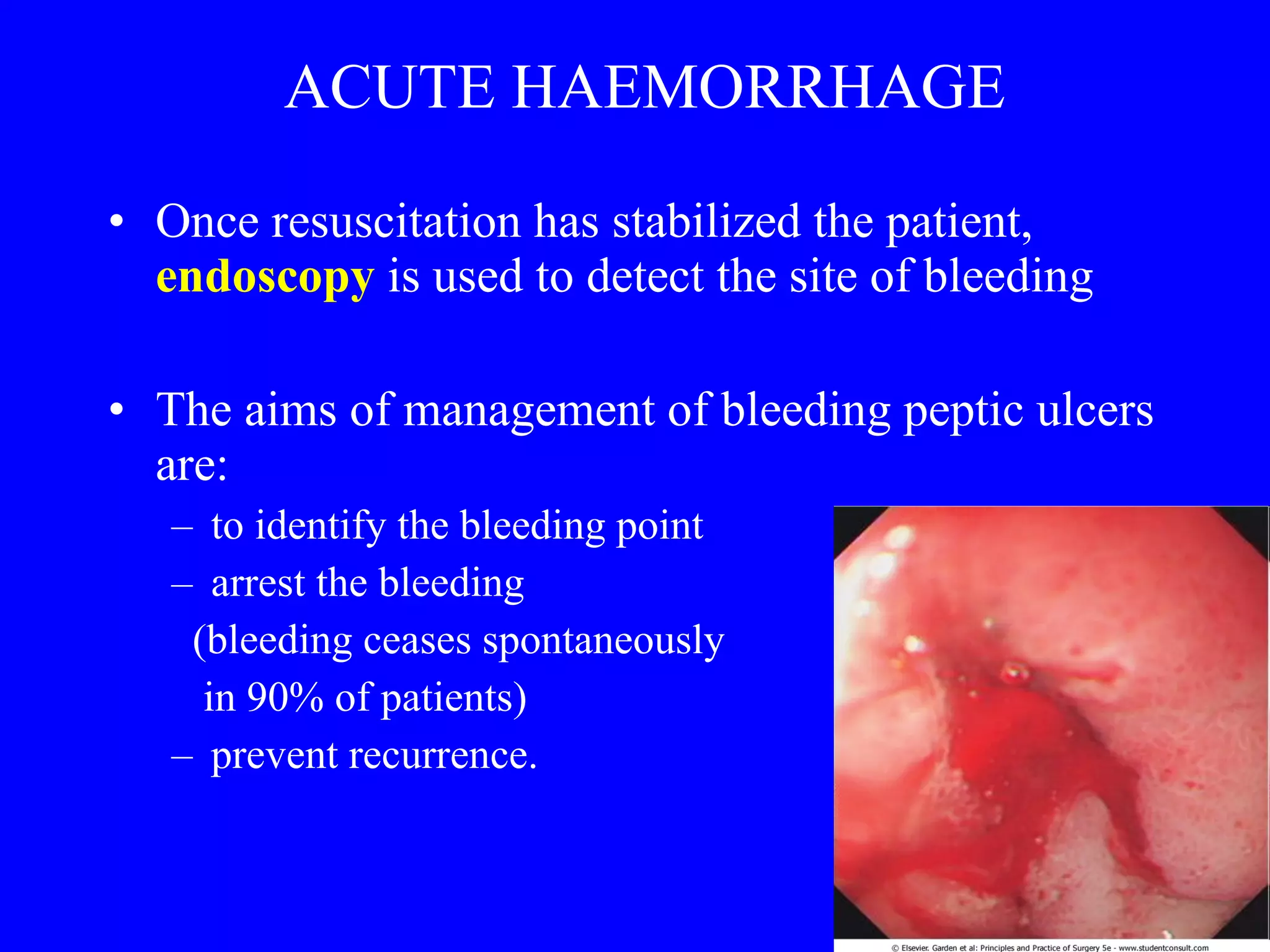 ACUTE HAEMORRHAGE Once resuscitation has stabilized the patient,  endoscopy  is used to detect the site of bleeding The aims of management of bleeding peptic ulcers are:  to identify the bleeding point arrest the bleeding  (bleeding ceases spontaneously in 90% of patients)  prevent recurrence.  