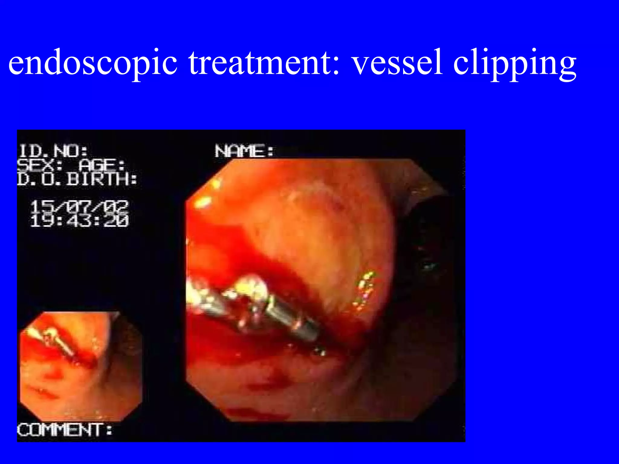 endoscopic treatment: vessel clipping 