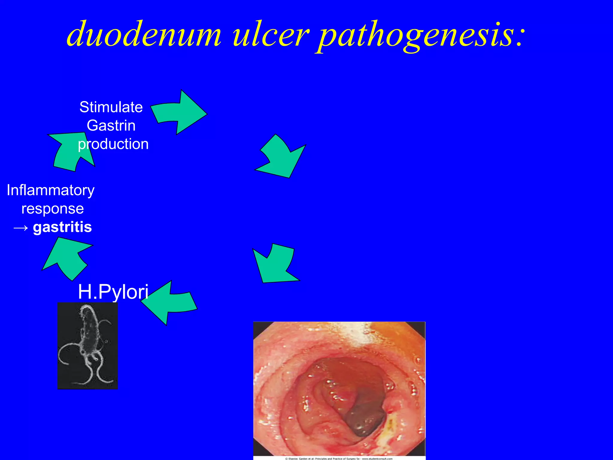 duodenum ulcer pathogenesis: H.Pylori Inflammatory  response ->   gastritis Stimulate  Gastrin  production 