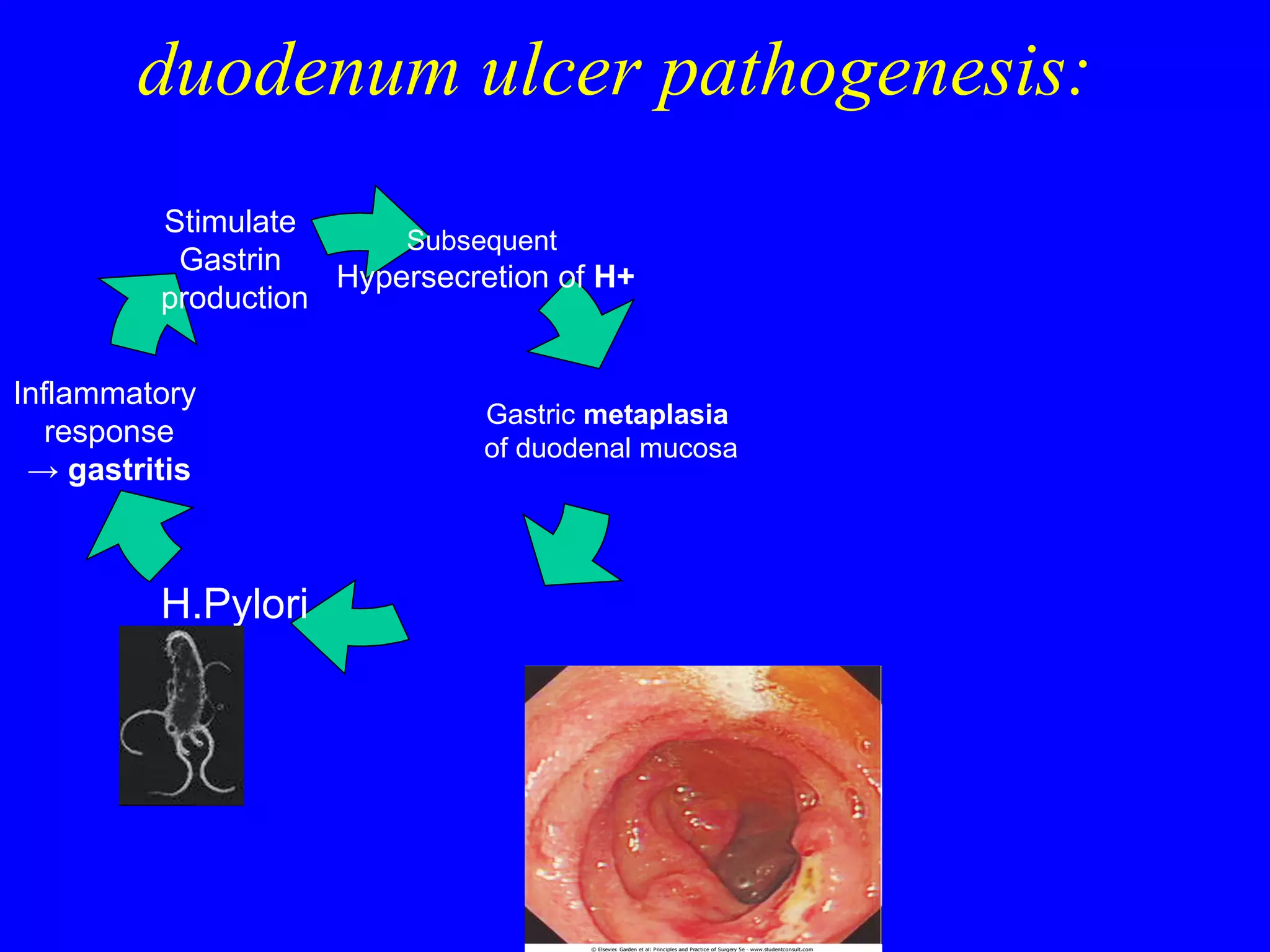 duodenum ulcer pathogenesis: Subsequent  Hypersecretion of  H + H.Pylori Inflammatory  response ->   gastritis Stimulate  Gastrin  production Gastric  metaplasia  of duodenal mucosa 