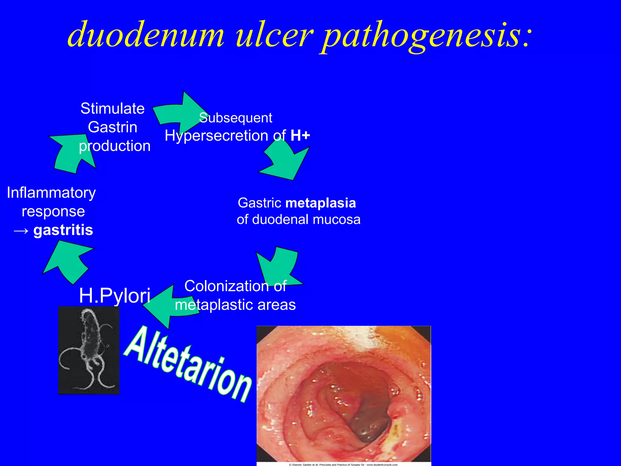 duodenum ulcer pathogenesis: Altetarion Subsequent  Hypersecretion of  H + Colonization of  metaplastic areas  H.Pylori Inflammatory  response ->   gastritis Stimulate  Gastrin  production Gastric  metaplasia  of duodenal mucosa 