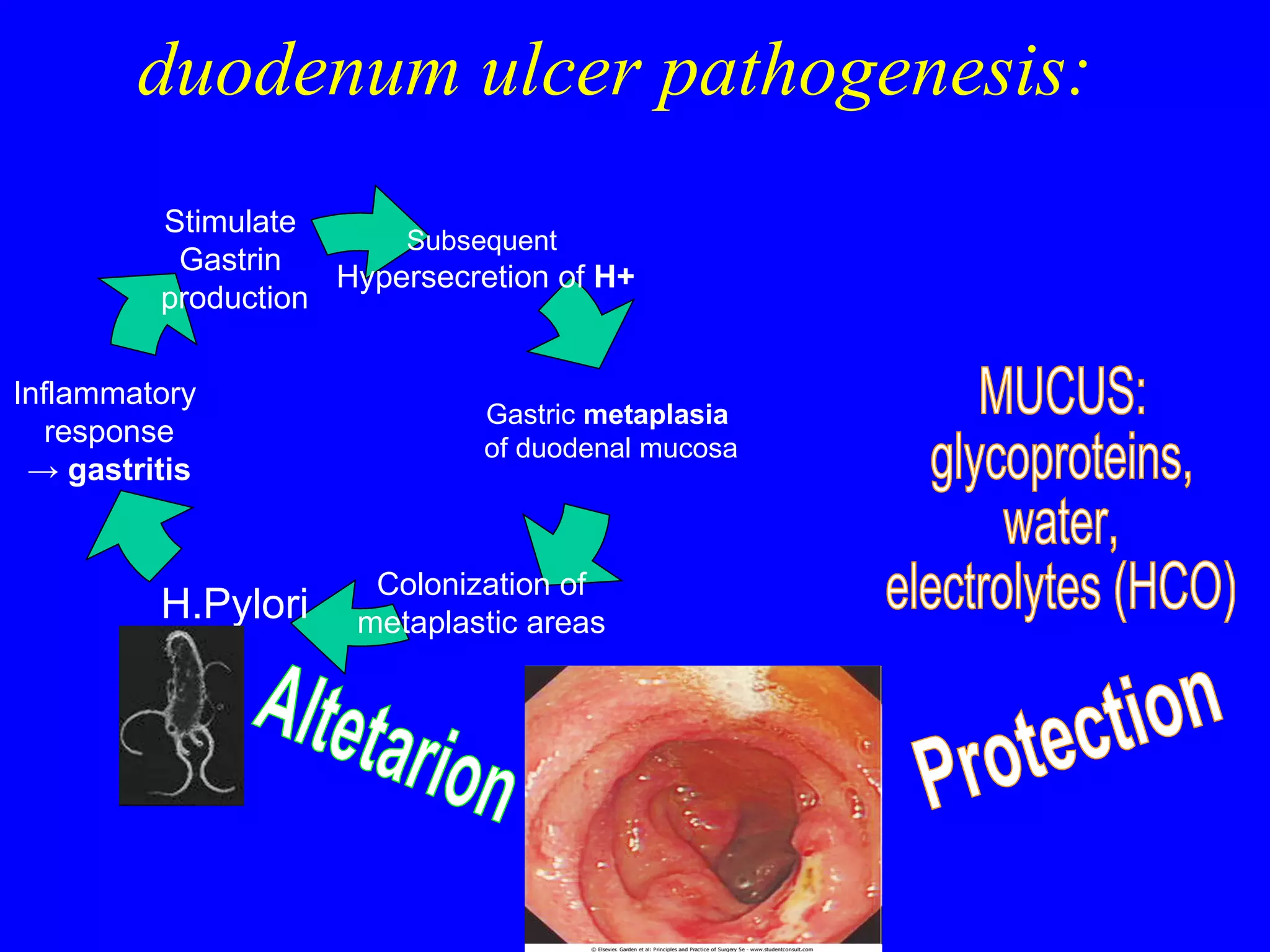 duodenum ulcer pathogenesis: Altetarion Protection MUCUS: glycoproteins, water,  electrolytes (HCO) Subsequent  Hypersecretion of  H + Colonization of  metaplastic areas  H.Pylori Inflammatory  response ->   gastritis Stimulate  Gastrin  production Gastric  metaplasia  of duodenal mucosa 