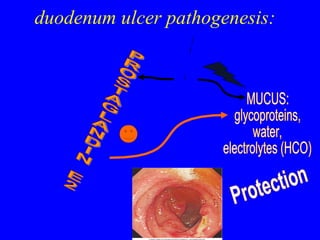 duodenum ulcer pathogenesis: Protection MUCUS: glycoproteins, water,  electrolytes (HCO) NSAIDs PROSTAGLANDIN E2 