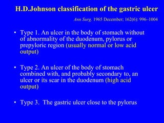 H.D.Johnson classification of the gastric ulcer   Ann Surg.  1965 December; 162(6): 996–1004   ,[object Object],[object Object],[object Object]