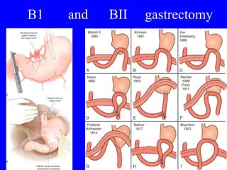 B1  and  BII  gastrectomy 
