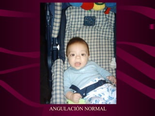 ANGULACIÓN NORMAL 
