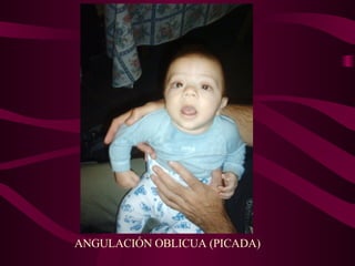 ANGULACIÓN OBLICUA (PICADA) 