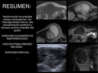 RESUMEN:
Neoformación de probable
estirpe mesenquimal, con
heterogeneidad interna, alta
vascularización periferica y
necrosis central; probable alto
grado.
SARCOMA PLEOMÓRFICO
INDIFERENCIADO.
HISTIOCITOMA FIBROSO
MALIGNO.
SARCOMA SINOVIAL.
...
 